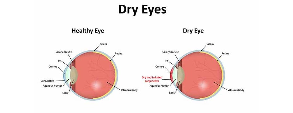 Dry-Eyes